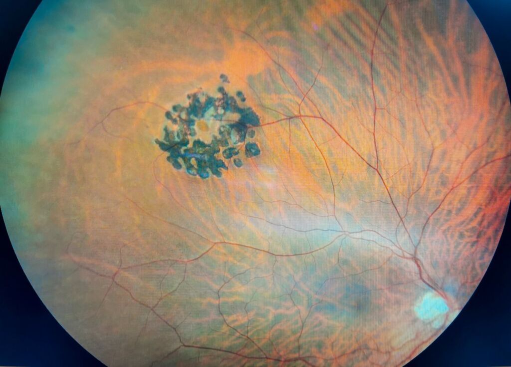 Photograph,Of,Retina,Showing,Laser,Treatment,To,Hole,In,Retina