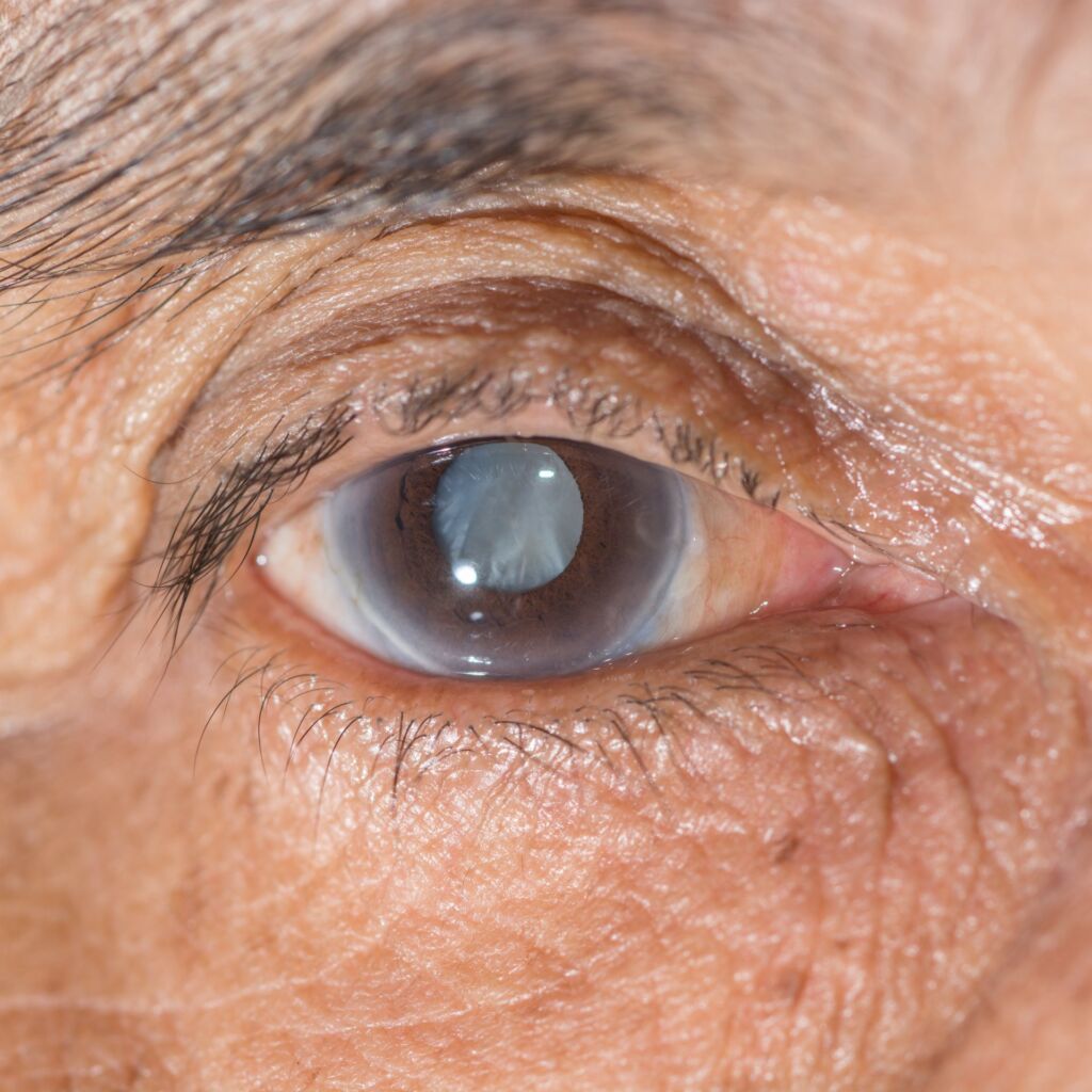 Close,Up,Of,The,Senile,Cataract,During,Eye,Examination.